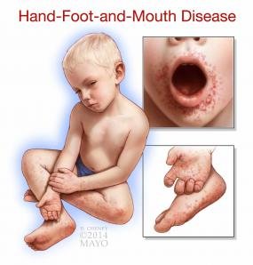 BVI Health Advisory Issued On Hand, Foot And Mouth Disease
