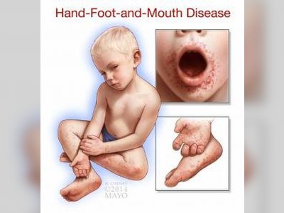 BVI Health Advisory Issued On Hand, Foot And Mouth Disease