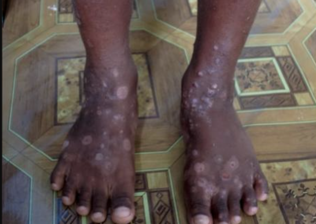 New infectious skin disease emerges in Haiti