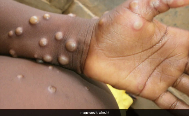 Explained: What Is Monkeypox And Why Cases Are Rising In Europe