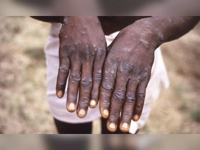 Haiti probing first suspected case of Monkeypox