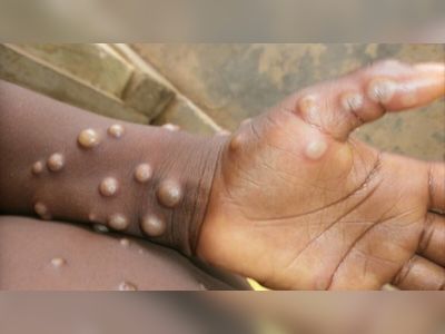 New York urges WHO to ‘immediately’ rename monkeypox