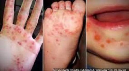 8 suspected cases of Hand Foot & Mouth Disease in VI